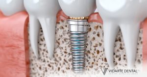 Implante Dental Sin Hueso