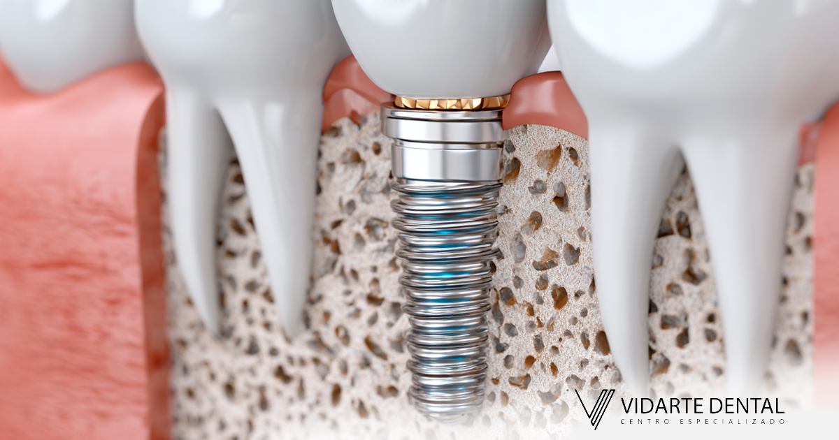 Implante Dental Sin Hueso