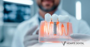 Implantes Dentales ¿Son adecuados para mí?