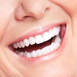 Prótesis dentales en Málaga